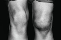 Kniescheibe - Gesunde (links) und verletzte Kniescheibe an einem Beinpaar