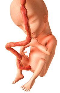 Nabelschnur - Baby mit Nabelschnur Nabelschnur - Baby mit Nabelschnur