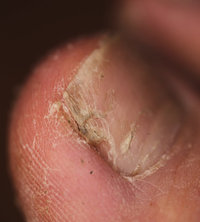 Pilz - Pilz am Nagel des Fußes